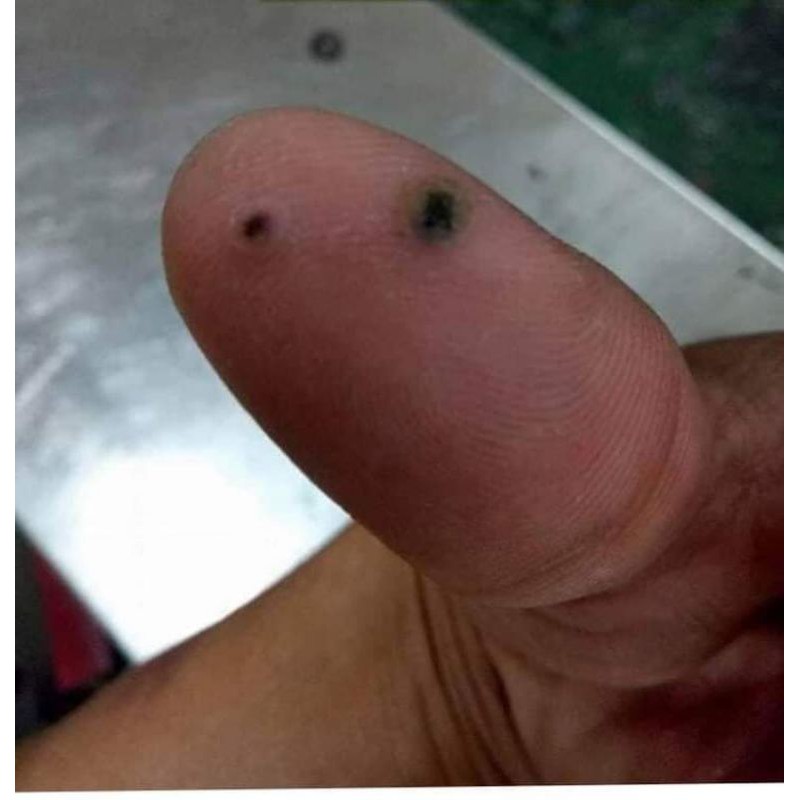 dung dịch diệt mụn cơm, mụn cóc, sạn cá | BigBuy360 - bigbuy360.vn