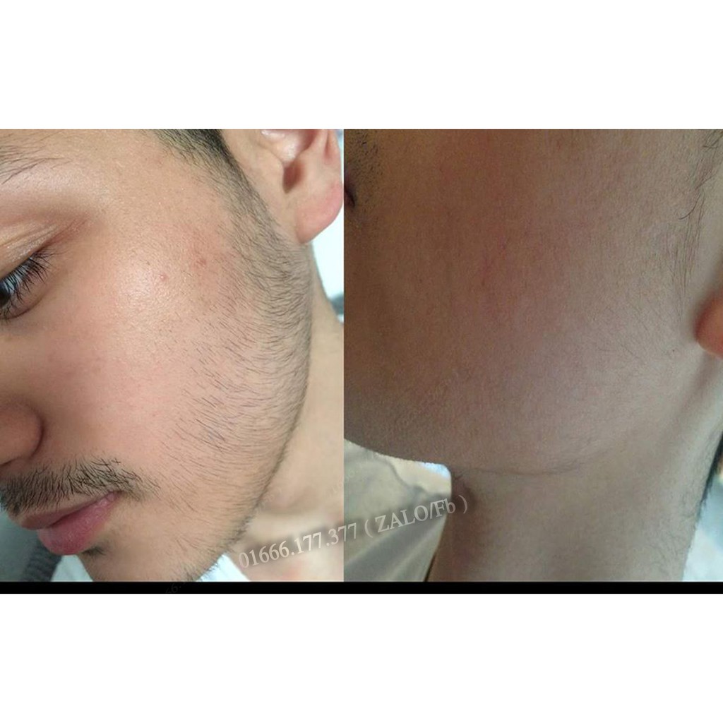 Minoxidil 5% Kirkland chính hãng - Thuốc Mọc Râu Tóc - Trị Hói - Dưỡng rậm Chân Mày | BigBuy360 - bigbuy360.vn