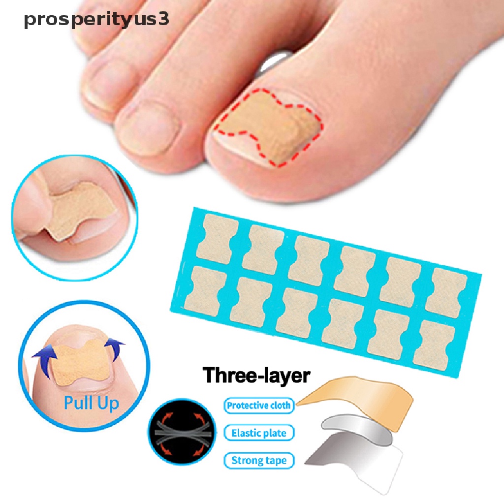 [prosperityus3] Ingrown Toenail Correction Tool Toe Nail Treatment Elastic Patch Sticker Clip [new]