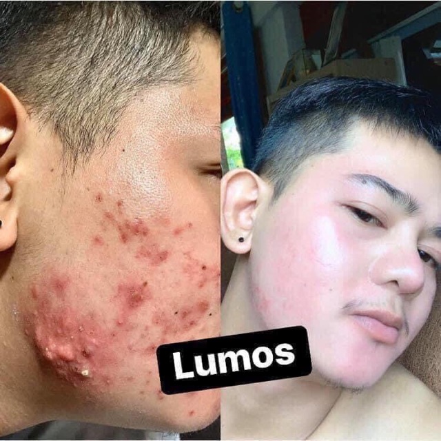 Serum Mụn Lumos Acne | BigBuy360 - bigbuy360.vn