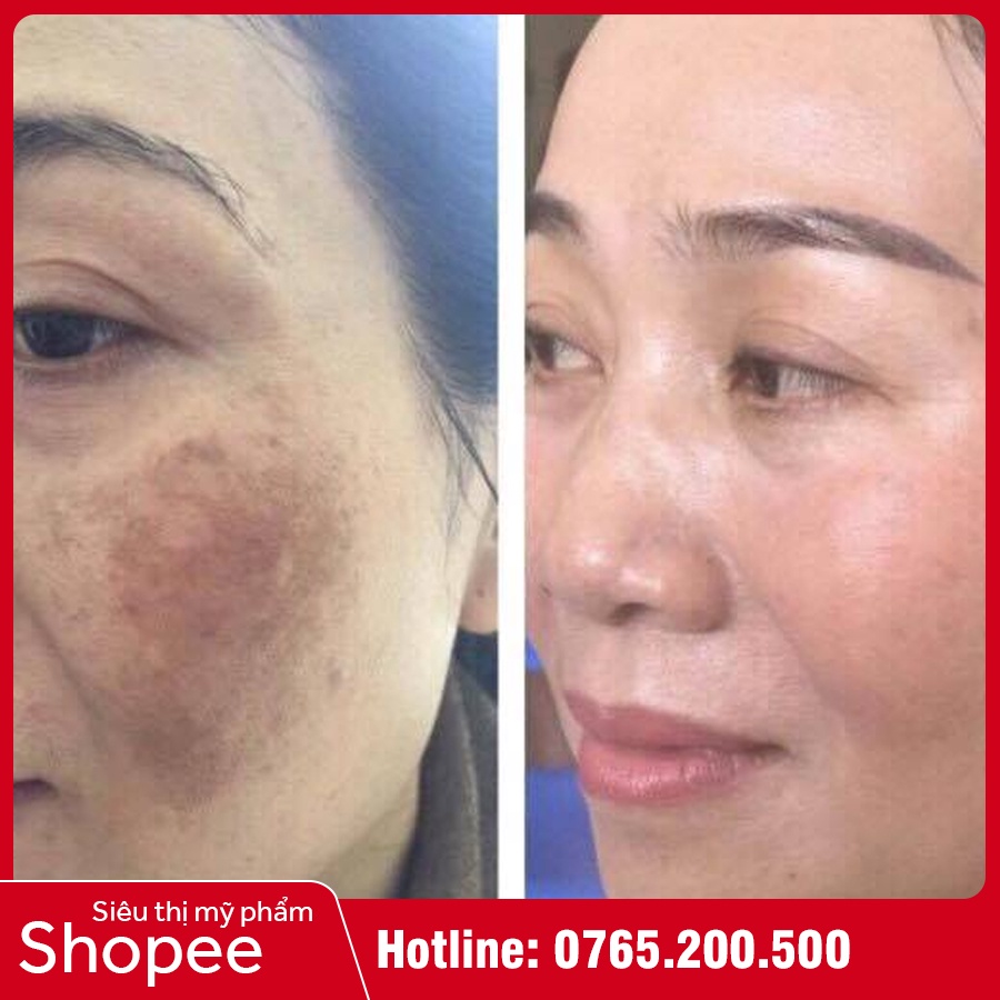 Kem Chống Nắng Mờ Nám Medi White - Medi UV Melasma - Bảo Vệ Da, Ngừa Sạm Nám, Tàn Nhang | BigBuy360 - bigbuy360.vn