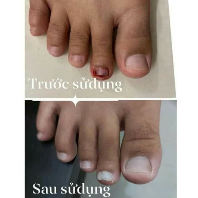 Điều trị nấm móng Varisi