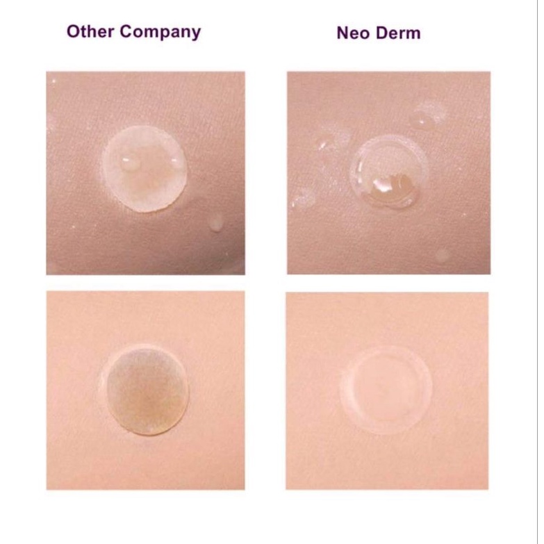 MIẾNG DÁN NGỪA VÀ CHE MỤN MỦ-VẾT THƯƠNG LASER 1 PATCH 48 MIẾNG