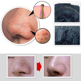 Gel lột mụn  Celona