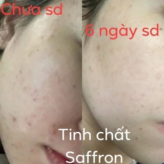 Tinh Chất Sâm Đất Saffron Dr Cell 20ml giảm mụn ngăn ngừa mụn trắng da
