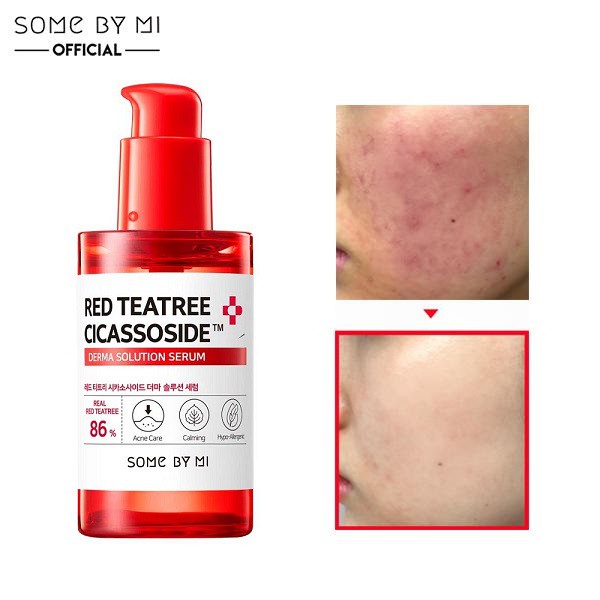 Tinh Chất Làm Dịu Da Mụn, Nhạy Cảm Chiết Xuất Tràm Trà Đỏ Some By Mi Red Teatree Cicassoside Derma Solution Serum 50ml