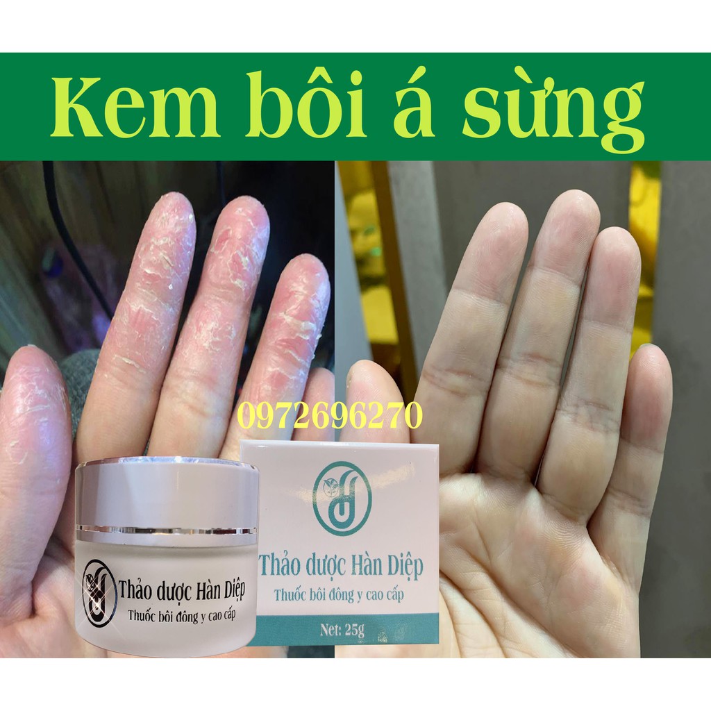 Kem bôi đặc tri Á Sừng - Hàn Diệp [ Cực hiệu quả ]