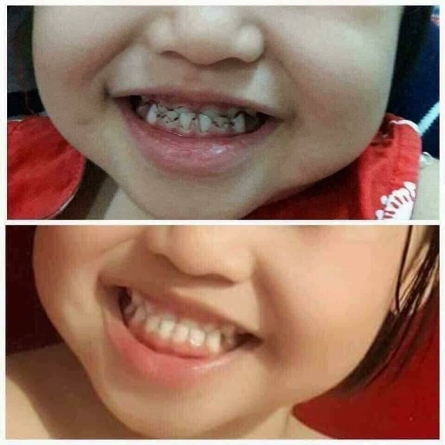 Kem đánh trắng răng