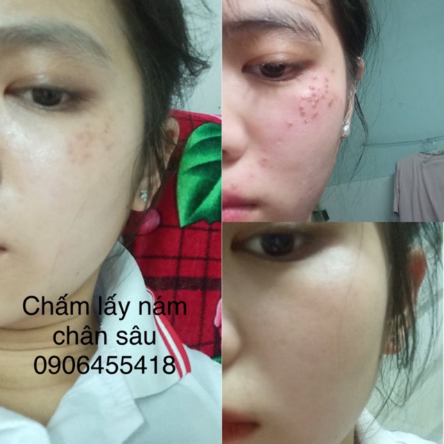 Chấm nám chân sâu , nám đinh