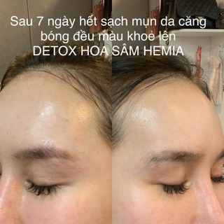 Detox mụn Hoa Sâm Hemia