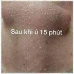 Ủ Mụn YOUNGERC Chính HãNG Chuyên Dùng Cho SPA TMV | BigBuy360 - bigbuy360.vn