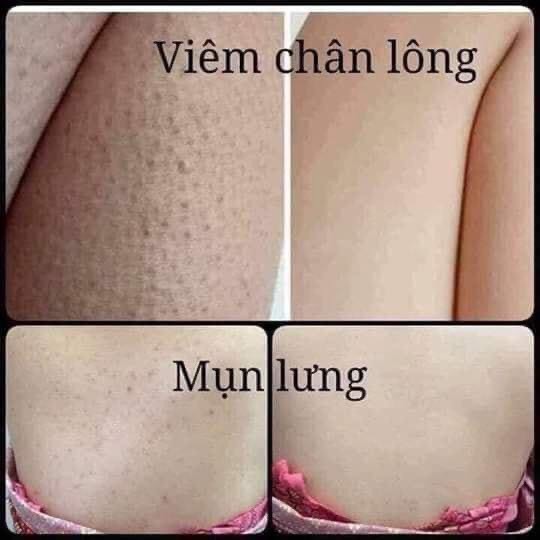 MEN VI SINH TAVIDA HẾT MỤN LƯNG, VIÊM NANG LÔNG, MẨN NGỨA