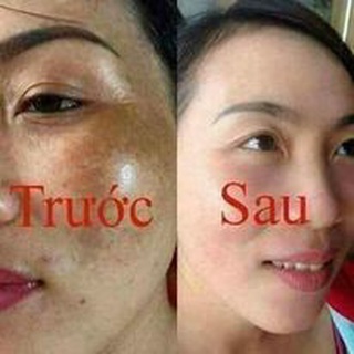 Bộ kem Nám Cherry đỏ Thái Lan