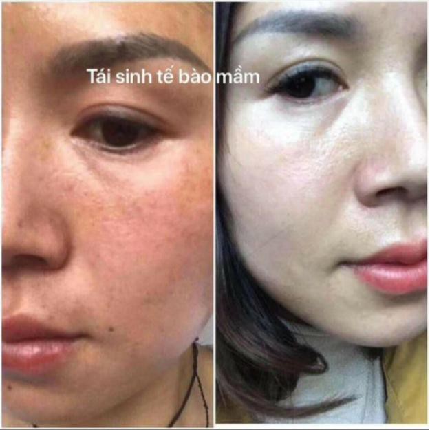 [Chuẩn Hàn]BỘ TÁI SINH TẾ BÀO MẦM