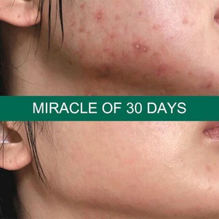 Serum Some By Mi AHA BHA PHA 30 Days Miracle