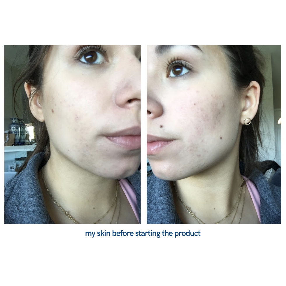 Thanh tẩy da AHA 30% + BHA 2% Peeling Solution The Ordinary 30ml | BigBuy360 - bigbuy360.vn