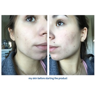 Thanh tẩy da AHA 30% + BHA 2% Peeling Solution The Ordinary 30ml