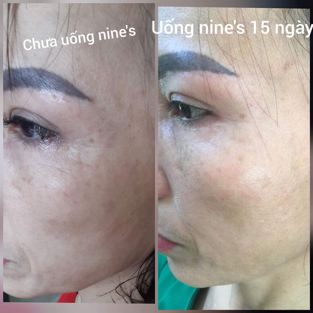 Viên Uống Trắng Da Toàn Thân Mờ Nám Giảm Nếp Nhăn Nine's Beauty