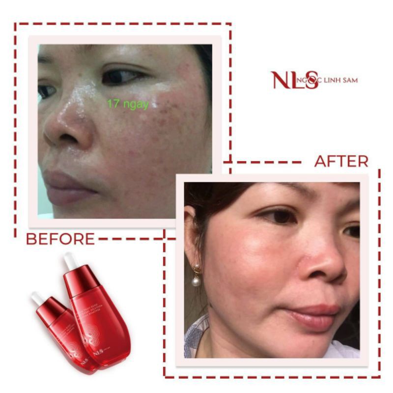 VUA XÓA NÁM, TÀN NHANG, MỤN LINH CHI ĐỎ NGỌC LINH SÂM | BigBuy360 - bigbuy360.vn