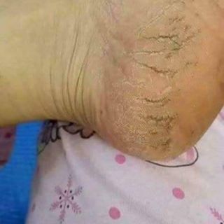 Kem chuối dưỡng nứt gót chân