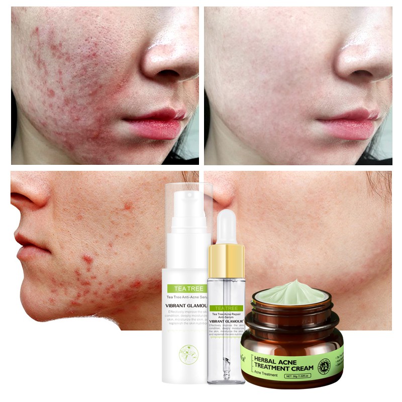 Set 3 sản phẩm VIBRANT GLAMOUR chiết xuất tràm trà cải thiện sẹo/mụn trứng cá chăm sóc da | BigBuy360 - bigbuy360.vn