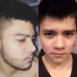 Combo 2 chai minoxidil 5% dạng Foam mọc râu tóc