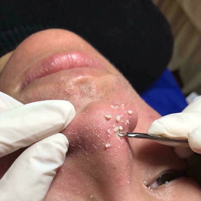 Que nặn mụn cám 2 đầu chất liệu thép không ghỉ
