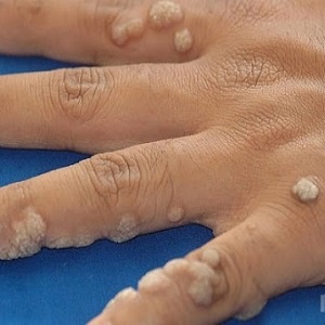 Mụn Cơm, Mụn Cóc, Mắt Cá Chân, Vết Chai Sần Acid Trivhloracetic 80% - Sống Chất 24h | BigBuy360 - bigbuy360.vn