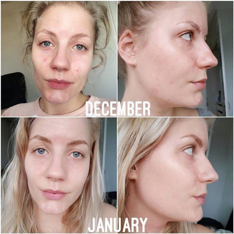 Tinh chất ngừa mụn, sáng da The Ordinary Niacinamide 10% + Zinc 1%