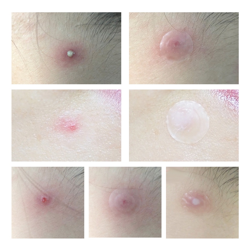 Bộ 25 Miếng Dán Giảm Mụn Lanbena Thiết Kế Vô Hình Chăm Sóc Da | BigBuy360 - bigbuy360.vn