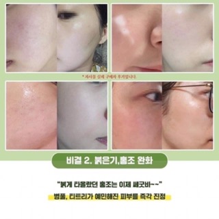 [Mẫu Thử] Bộ Dưỡng Dành Cho Da Mụn I'MeLe