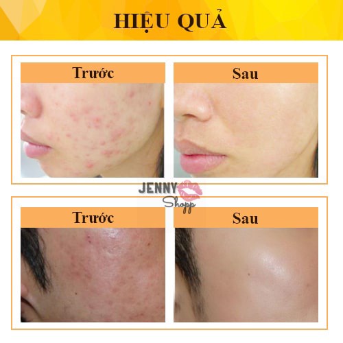 Kem Giảm Mụn Mờ Thâm Derma Forte