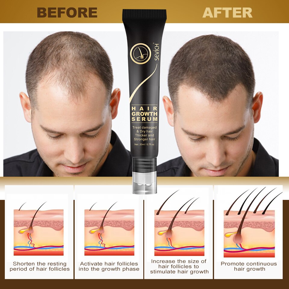 Serum Dưỡng Tóc Sevich 20ml Ngăn Rụng Tóc / Chăm Sóc Hư Tổn