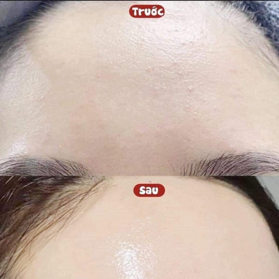 Kem Dưỡng Floslek Kiểm Soát Dầu Cấp Ẩm Anti Acne Mattifying Cream Ba Lan 50ml