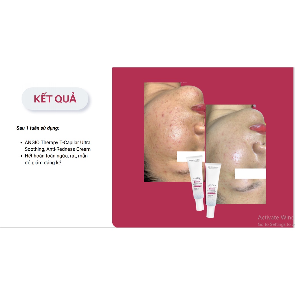 Kem Dưỡng Chuyên Dụng Da Nhạy Cảm, Giãn Mạch DERMEDIC REDNESS CALM ROSACEA PRONE SKIN Concentrate cream