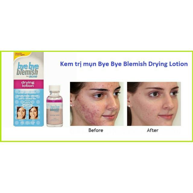 Chấm mụn Bye Bye Blemish Drying Lotion