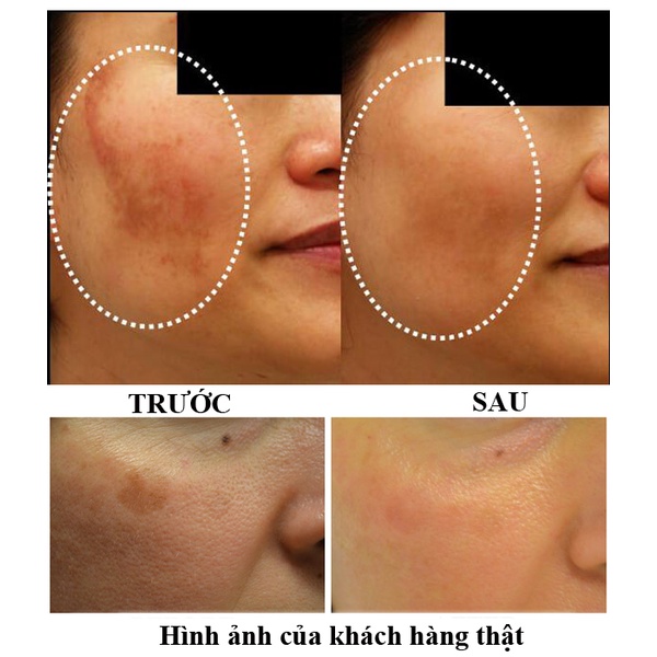 Viên Uống Mờ Nám, Tàn Nhang, Làm Trắng Da Transino Whitening Nhật Bản (240 Viên)