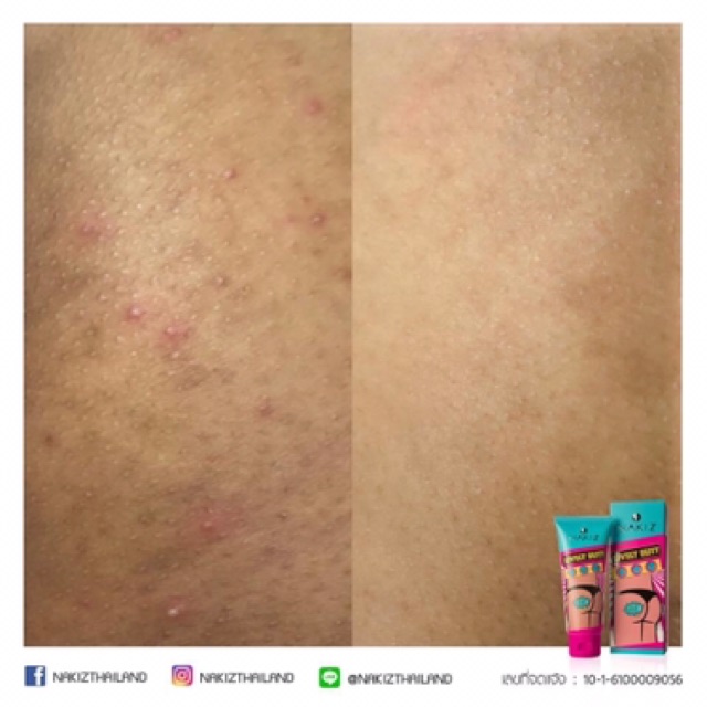 COMBO 2 NAKIZ LIVELY BUTT【CHÍNH HÃNG】 Kem giảm thâm, mụn Mông, Bẹn, Nách, Lưng, Nhũ hoa, Cùi chỏ, Đầu gối .... Thái Lan | BigBuy360 - bigbuy360.vn