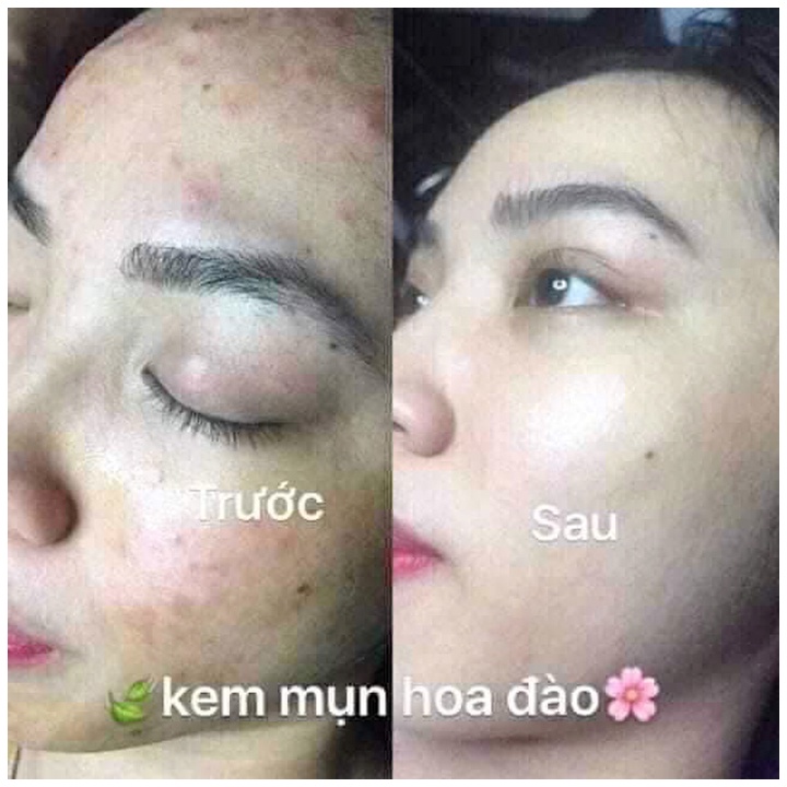 Kem Mụn Hoa Đào Giảm Thâm Mụn, Kem Đông Y Dưỡng Trắng Da Mờ Thâm