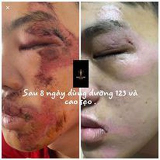 CAO SẸO BÁCH Y SÂM - BẠCH LINH