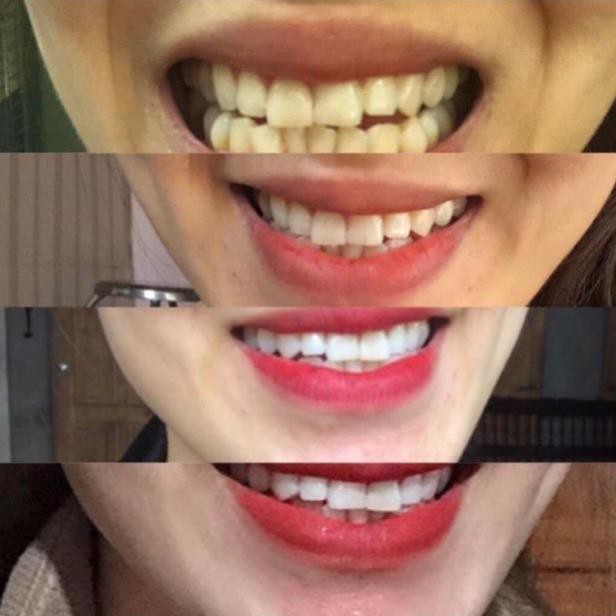 Gel Smilee Extra - V2.0- tẩy trắng răng tại nhà An toàn men răng, không ê buốt, ISO:22716 - 2007