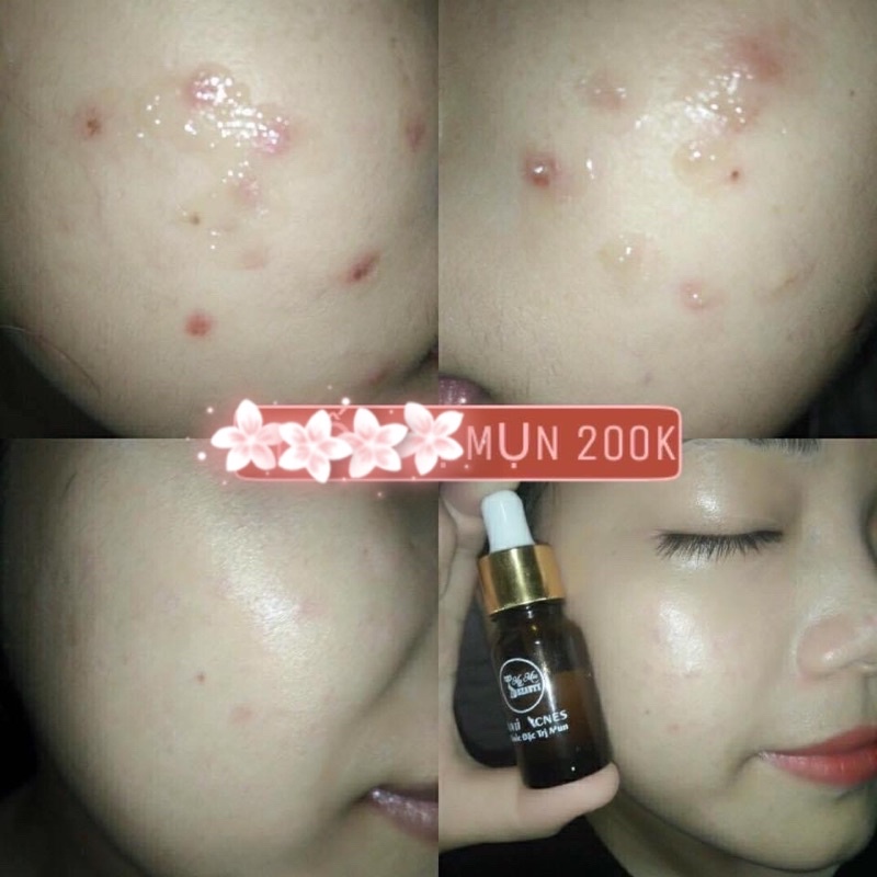 {Date 2024} SERUM GIẢM THÂM MỤN MY MIU HIỆU QUẢ 100%