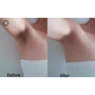 Hút thâm nách , thâm các vùng bikini OLCELL