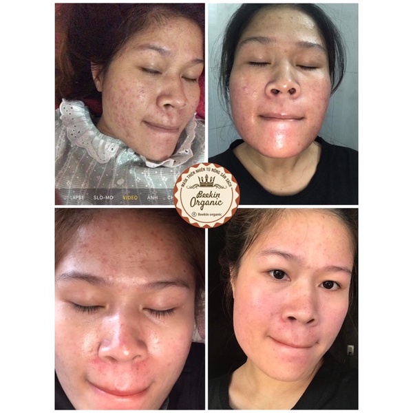 Mặt nạ sữa ong chúa tươi