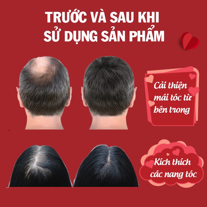 Viên uống mọc tóc Hairtonic, giúp giảm rụng tóc, nuôi dưỡng chân tóc chắc khỏe và dày mượt