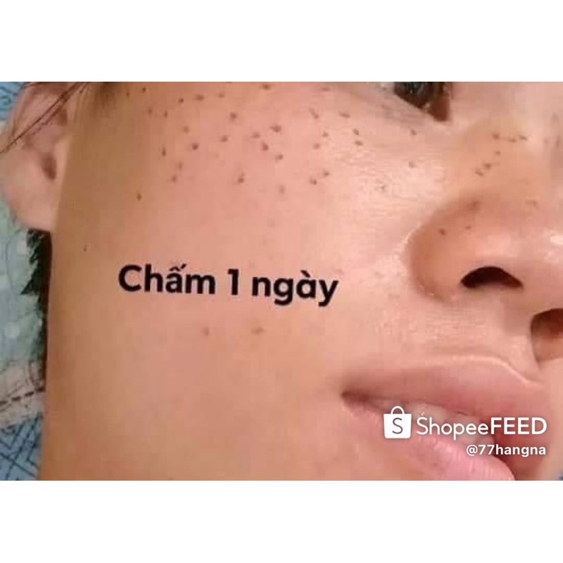 Chấm Tảo sống xoá tàn nhang