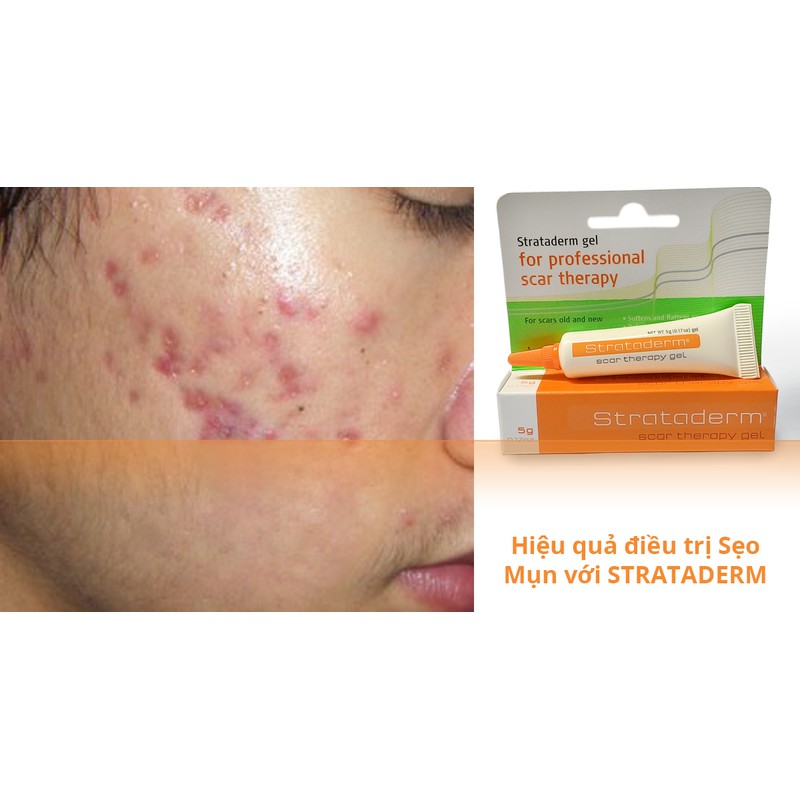 Strataderm – Gel làm mờ sẹo xấu - 5g 10g 20g