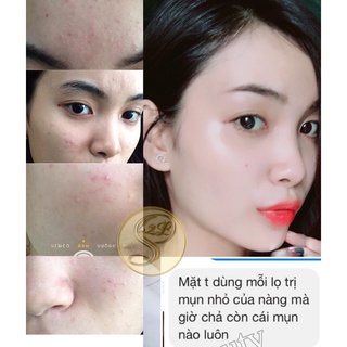 KEM NGỪA MỤN S2B BEAUTY