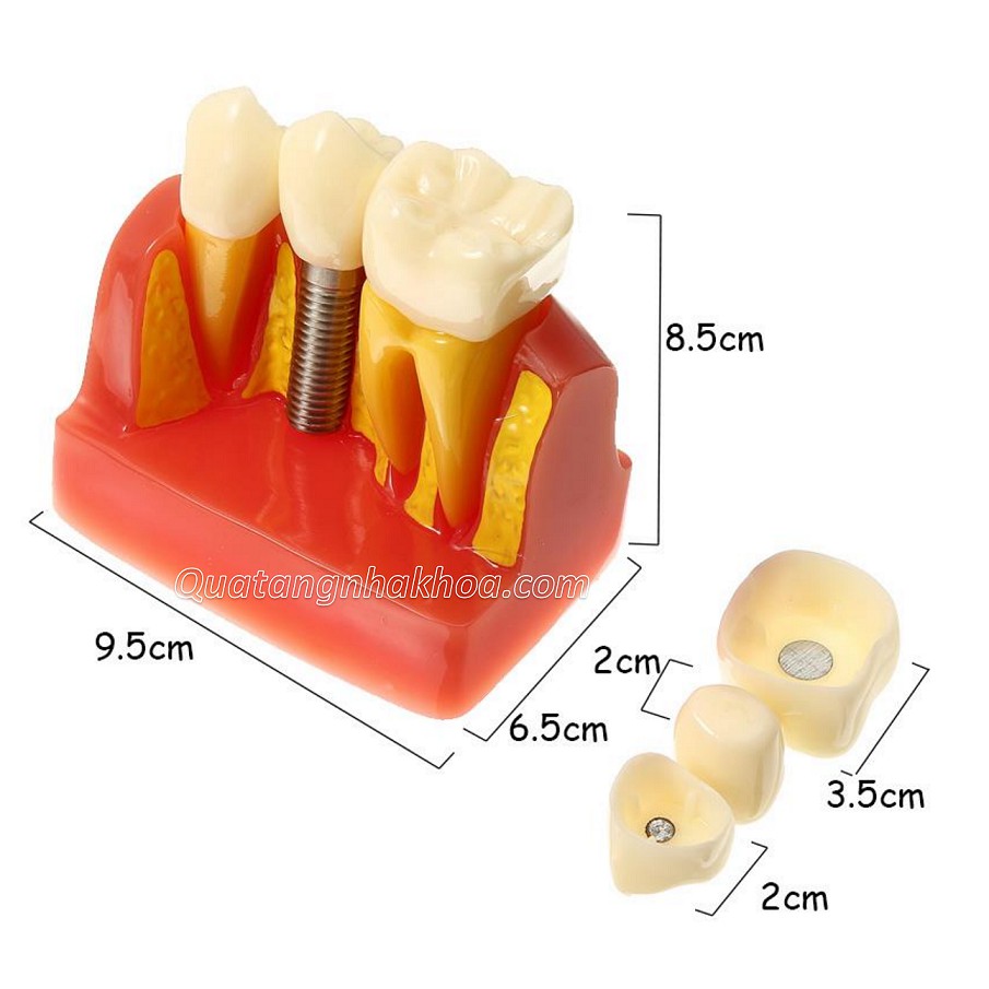 Mô hình hàm tư vấn so sánh cầu răng và implant - Mô hình răng thực hành nha khoa