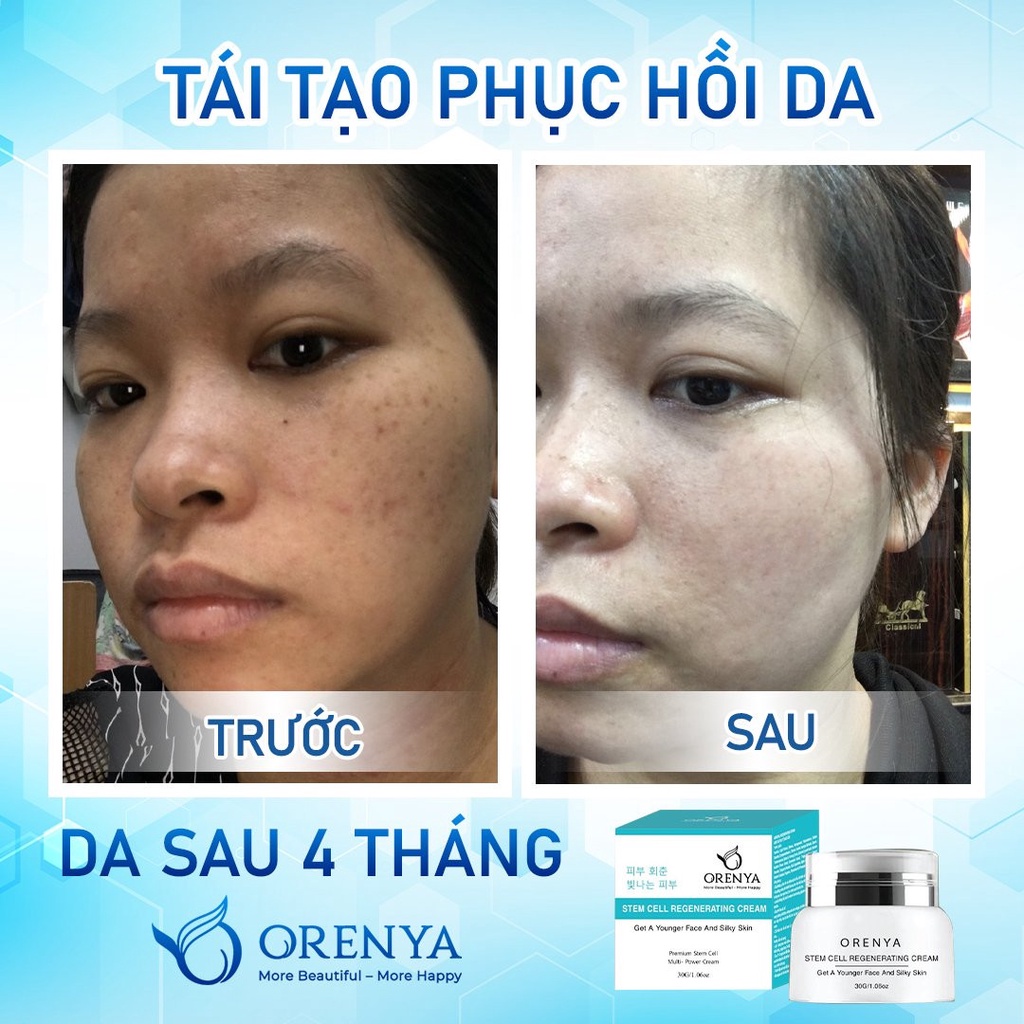 Kem Tái Tạo Tế Bào gốc - Phục Hồi Các Tế Bào Da Hư Tổn🌱 Làm Mờ Sẹo Rỗ, Sẹo Do Mụn